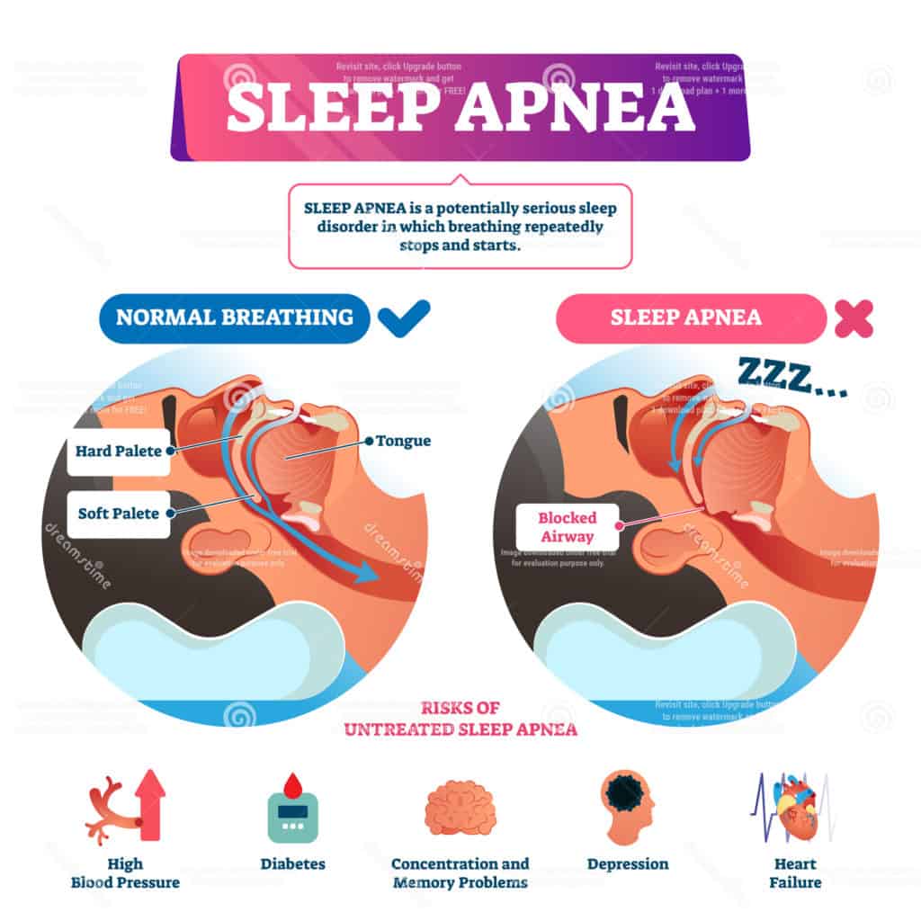 Sleep Apnea Chart